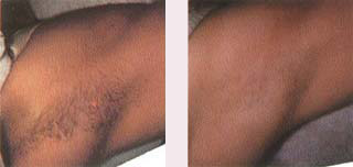under arm hair removal