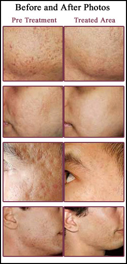 Acne Scar Removal Treatment Delhi