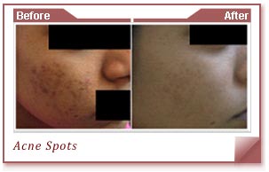 Acne Specialists In India
