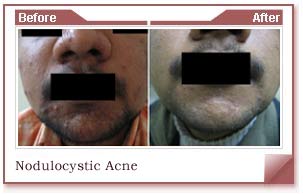 acne scar removal