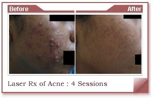 acne skin removal treatment