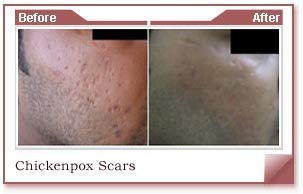 acne spots removal