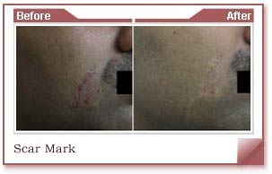 acne scar and spots removal