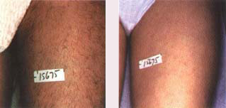 laser hair removal side effect